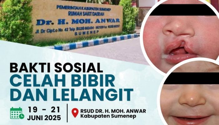 RSUD dr. H. Moh. Anwar Gelar Bakti Sosial Operasi Celah Bibir dan Lelangit Gratis